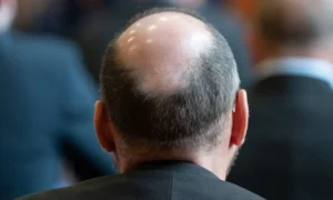 Лысина у мужчины