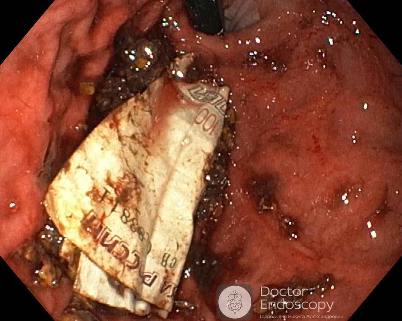 Снимок зонда в желудке пациента.