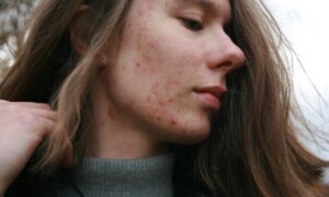 Лицо с высыпаниями