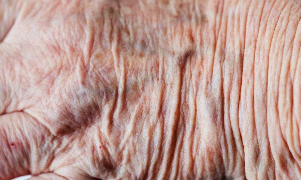 Дряблая кожа пожилого человека.