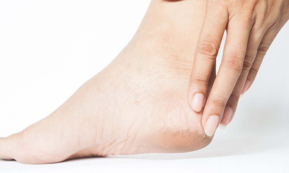 Потрескавшаяся кожа на пятке