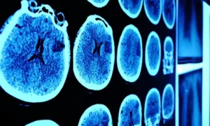 сканирование мозга