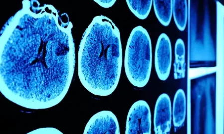 сканирование мозга