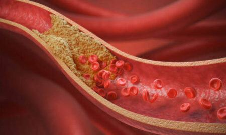 атеросклероз