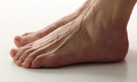 вены на ногах