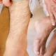 Атеросклероз